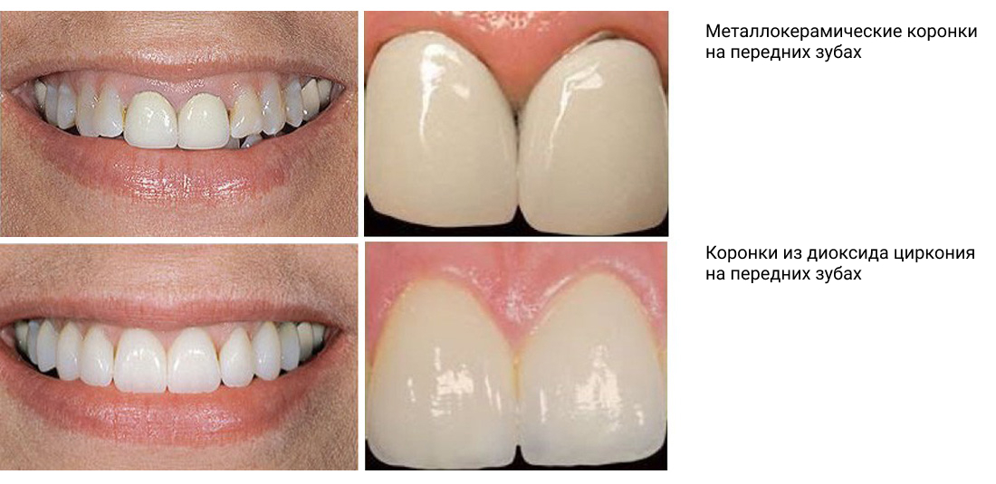 Фото - металлокерамические и циркониевые коронки на передних зубах, разница